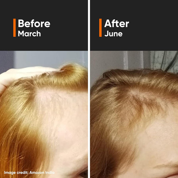 Minimalist Hair Growth Serum With 3% Redensyl, 3% Anagain, 3% Procapil, 5% Capixyl & 4% Baicapil 18% Hair Growth Actives | For Hair Fall Control | For Men & Women | 30 ml image 2